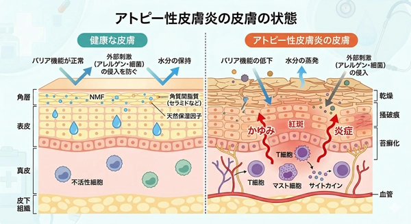 堺市のアトピー性皮膚炎治療｜皮膚科専門医在籍｜皮ふ科眼科くめ